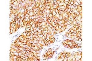 Formalin-paraffin human renal cell carcinoma stained with CAIX antibody (66. (CA9 Antikörper)