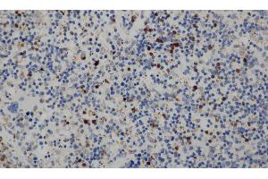Immunohistochemistry of paraffin-embedded Human cervical cancer tissue using CD68 Polyclonal Antibody at dilution 1:30 (CD68 Antikörper)