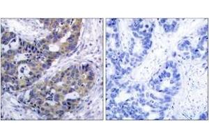 Immunohistochemistry analysis of paraffin-embedded human breast carcinoma tissue, using IRS-1 (Ab-312) Antibody. (IRS1 Antikörper  (AA 279-328))