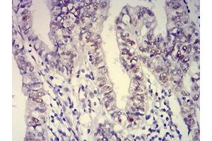 Immunohistochemical analysis of paraffin-embedded endometrial cancer tissues using ATXN1 mouse mAb with DAB staining. (Ataxin 1 Antikörper  (AA 645-815))