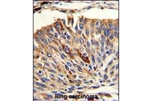 Formalin-fixed and paraffin-embedded human lung carcinoma with VTI1A Antibody (C-term), which was peroxidase-conjugated to the secondary antibody, followed by DAB staining. (VTI1A Antikörper  (C-Term))