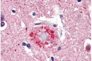 Human Brain, Cortex, Senile Plaque (formalin-fixed, paraffin-embedded) stained with Ubiquitin antibody ABIN462097 at 10 ug/ml followed by biotinylated goat anti-rabbit IgG secondary antibody ABIN481713, alkaline phosphatase-streptavidin and chromogen. (Ubiquitin Antikörper)