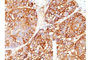 Formalin-fixed, paraffin-embedded human Melanoma stained with Melanoma Marker Mouse Monoclonal (DT101+ BC199 + T311 + HMB45). (Melanoma Marker (MART-1 + Tyrosinase + Gp100) Antikörper)