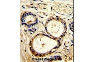 Formalin-fixed and paraffin-embedded human breast carcinoma with SRC8 Antibody (N-term), which was peroxidase-conjugated to the secondary antibody, followed by DAB staining. (SRC8 Antikörper  (N-Term))