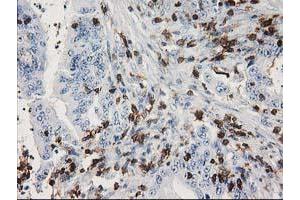 Immunohistochemical staining of paraffin-embedded Adenocarcinoma of Human colon tissue using anti-DEF8 mouse monoclonal antibody. (DEF8 Antikörper)