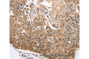 Immunohistochemistry of Human liver cancer using RBM38 Polyclonal Antibody at dilution of 1:45 (RBM38 Antikörper)