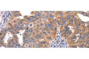 Immunohistochemistry of paraffin-embedded Human ovarian cancer tissue using IRS2 Polyclonal Antibody at dilution 1:100 (IRS2 Antikörper)