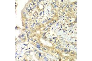 Immunohistochemistry of paraffin-embedded human liver cancer using TIMM17A antibody. (TIMM17A Antikörper  (AA 1-171))