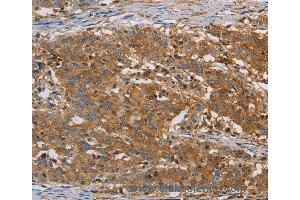 Immunohistochemistry of Human gastic cancer using CFL1 Polyclonal Antibody at dilution of 1:30 (Cofilin Antikörper)