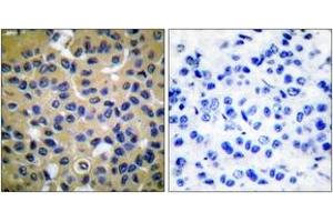 Immunohistochemistry analysis of paraffin-embedded human breast carcinoma tissue, using Collagen II Antibody. (COL2 Antikörper  (AA 101-150))
