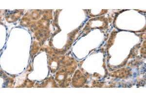 Immunohistochemistry of paraffin-embedded Human thyroid cancer tissue using Laminin alpha4 Polyclonal Antibody at dilution 1:30 (LAMa4 Antikörper)