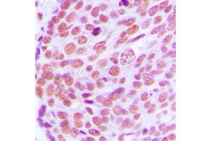 Immunohistochemical analysis of Lamin A/C staining in human breast cancer formalin fixed paraffin embedded tissue section. (Lamin A/C Antikörper  (Center))