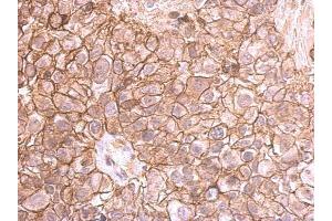 Immunohistochemistry (IHC) image for anti-Cadherin 1, Type 1, E-Cadherin (Epithelial) (CDH1) antibody (ABIN2854751)