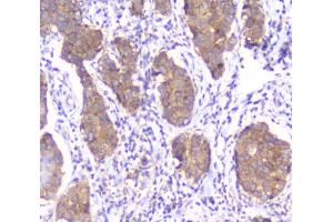 IHC testing of FFPE human breast cancer with SMN1/2 antibody. (SMN1 / SMN2 Antikörper)