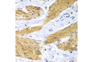 Immunohistochemistry of paraffin-embedded human gastric cancer using HRAS antibody. (HRAS Antikörper)