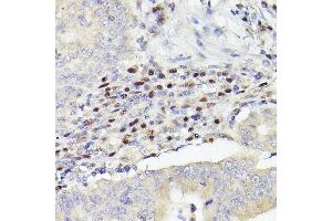 Immunohistochemistry of paraffin-embedded human colon carcinoma using MEF2A+MEF2C Rabbit mAb (ABIN1679049, ABIN1679050, ABIN7101495 and ABIN7101496) at dilution of 1:100 (40x lens). (MEF2A+MEF2C Antikörper)