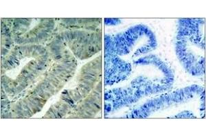 Immunohistochemistry analysis of paraffin-embedded human colon carcinoma, using Src (Phospho-Tyr418) Antibody. (Src Antikörper  (pTyr419))
