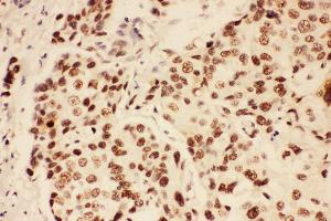 Anti-BRCA1 Picoband antibody,  IHC(P): Human Mammary Cancer Tissue (BRCA1 Antikörper  (AA 1661-1863))