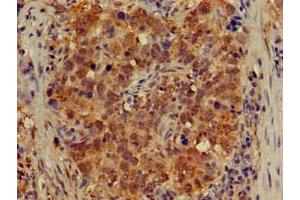 Immunohistochemistry of paraffin-embedded human pancreatic cancer using ABIN7149021 at dilution of 1:100 (ATG4B Antikörper  (AA 350-400))