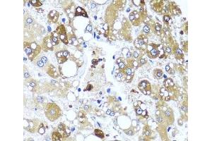 Immunohistochemistry of paraffin-embedded Human liver damage using IL4 Polyclonal Antibody at dilution of 1:100 (40x lens). (IL-4 Antikörper)