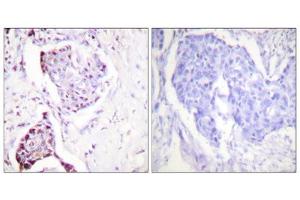 Immunohistochemistry analysis of paraffin-embedded human breast carcinoma tissue, using Ubiquitin antibody. (Ubiquitin Antikörper  (Internal Region))