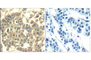 Immunohistochemical analysis of paraffin-embedded human breast carcinoma tissue using Met (Ab-1003) Antibody (E021548). (c-MET Antikörper)