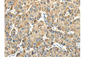 The image on the left is immunohistochemistry of paraffin-embedded Human liver cancer tissue using ABIN7131400(TMPRSS11E Antibody) at dilution 1/30, on the right is treated with fusion protein. (TMPRSS11E Antikörper)