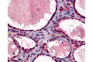 Anti-TSH Receptor / TSHR antibody IHC of human Thyroid, Follicular Carcinoma. (TSH receptor Antikörper  (C-Term))