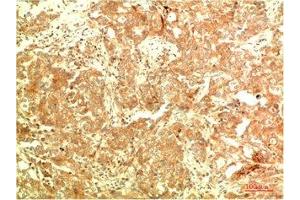 Immunohistochemical analysis of paraffin-embedded Human Breast Carcinoma Tissue using ATG5 Mouse mAb diluted at 1:2000 (ATG5 Antikörper)