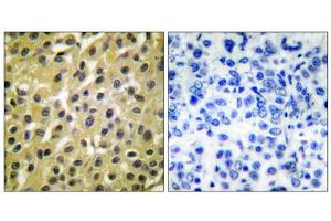 Immunohistochemical analysis of paraffin-embedded human breast carcinoma tissue, using MDM2 antibody (ABIN5976454). (MDM2 Antikörper  (C-Term))