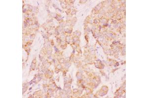 Anti-AAMP Picoband antibody,  IHC(P): Human Mammary Cancer Tissue (AAMP Antikörper  (AA 235-434))