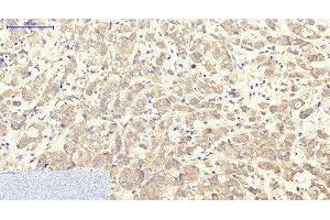 Immunohistochemistry of paraffin-embedded Human breast cancer tissue using ITGA2B Monoclonal Antibody at dilution of 1:200. (Integrin Alpha2b Antikörper)