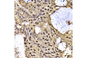 Immunohistochemistry of paraffin-embedded human oophoroma using ARID3A antibody. (ARID3A Antikörper)