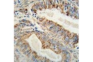 Anti-AKT2 antibody immunohistochemistry analysis in formalin fixed and paraffin embedded human prostate carcinoma. (AKT2 Antikörper)