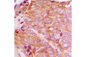 Immunohistochemical analysis of YTHDF1 staining in human breast cancer formalin fixed paraffin embedded tissue section. (YTHDF1 Antikörper  (N-Term))