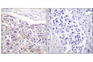 Immunohistochemical analysis of paraffin-embedded human breast carcinoma tissue using p90 RSK (Phospho-Thr573) antibody (left)or the same antibody preincubated with blocking peptide (right). (RPS6KA1 Antikörper  (pThr573))