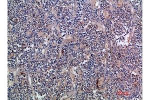 Immunohistochemical analysis of paraffin-embedded human-kidney-cancer, antibody was diluted at 1:200. (EGF Antikörper  (AA 1000-1060))