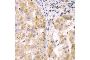 Immunohistochemistry of paraffin-embedded human liver cancer using SULT2B1 antibody at dilution of 1:100 (x40 lens). (SULT2B1 Antikörper)