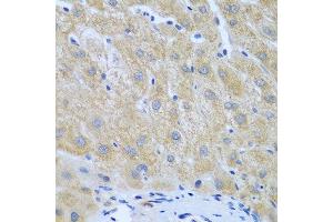 Immunohistochemistry of paraffin-embedded human liver cancer using FURIN antibody at dilution of 1:100 (40x lens). (FURIN Antikörper)