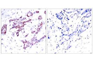 Immunohistochemical analysis of paraffin-embedded human breast carcinoma tissue using STAT1 (phospho-Tyr701) antibody (E011044). (STAT1 Antikörper  (pTyr701))