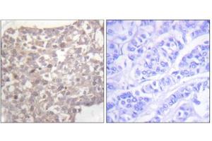 Immunohistochemistry analysis of paraffin-embedded human breast carcinoma tissue, using Tubulin gamma antibody. (TUBG1 Antikörper  (C-Term))