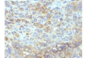 Formalin-fixed, paraffin-embedded human Melanoma stained with CD54 Monoclonal Antibody (W-CAM-1). (ICAM1 Antikörper)