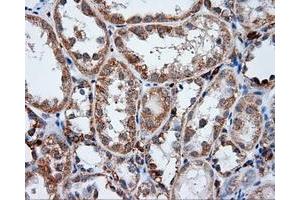 Immunohistochemical staining of paraffin-embedded Adenocarcinoma of ovary tissue using anti-LIPG mouse monoclonal antibody. (LIPG Antikörper)