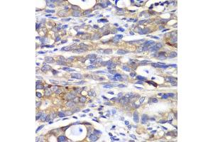 Immunohistochemistry of paraffin-embedded human gastric cancer using H antibody (ABIN6129787, ABIN6141601, ABIN6141603 and ABIN6216048) at dilution of 1:100 (40x lens). (HAPLN1 Antikörper  (AA 165-354))