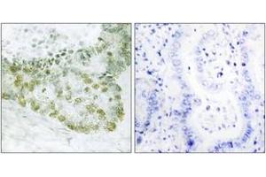 Immunohistochemistry analysis of paraffin-embedded human lung carcinoma tissue, using Hic-5 (Ab-60) Antibody. (TGFB1I1 Antikörper  (AA 31-80))