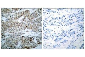 Immunohistochemical analysis of paraffin-embedded human breast carcinoma tissue using BAD(Phospho-Ser112) Antibody(left) or the same antibody preincubated with blocking peptide(right). (BAD Antikörper  (pSer112))