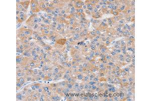 Immunohistochemistry of Human liver cancer using SLC25A13 Polyclonal Antibody at dilution of 1:35 (slc25a13 Antikörper)