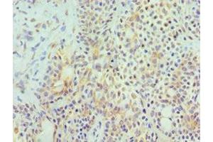 Immunohistochemistry of paraffin-embedded human breast cancer using ABIN7155972 at dilution of 1:100 (HYAL3 Antikörper  (AA 198-417))