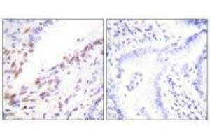 Immunohistochemistry analysis of paraffin-embedded human lung carcinoma tissue, using Ki67antibody. (Ki-67 Antikörper  (C-Term))