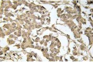 Immunohistochemistry (IHC) analyzes of p-eIF2alpha in paraffin-embedded human breast carcinoma tissue. (EIF2S1 Antikörper  (pSer51))
